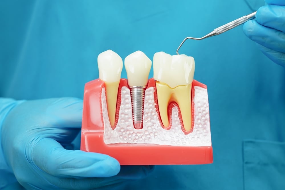 Dental Implants Gilbert